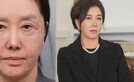 유혜리, 안면거상 시술 후 근황…세상 놀란 비주얼
