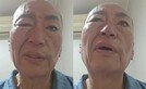 ‘결혼 8번’ 유퉁, 입 돌아가고 눈 안 감겨…안면마비 심각